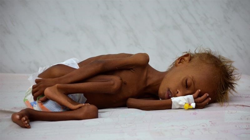 Kelaparan melanda banyak rakyat Yaman, mereka tak kuasa memenuhi kebutuhan makanan akibat terjadinya perang sipil. Program Pangan Dunia memperkirakan sekitar 14 juta orang Yaman mengais makanan yang tidak bergizi dan tidak sehat.(Al Jazeera/Reuters)