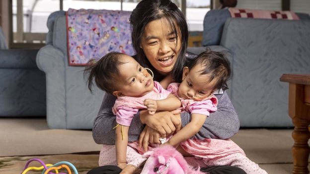 Kembar siam asal Bhutan Nima dan Dawa bersama ibu mereka, Bhumchu Zangmo, menjelang menjalani operasi di Melbourne, Australia. (Foto: EPA/BBC News)